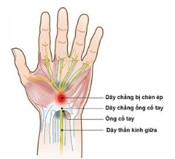 HỘI CHỨNG ỐNG CỔ TAY (Carpal tunnel syndrome)